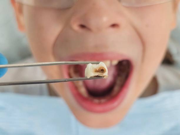 Best Emergency Tooth Extraction in Navarre, FL